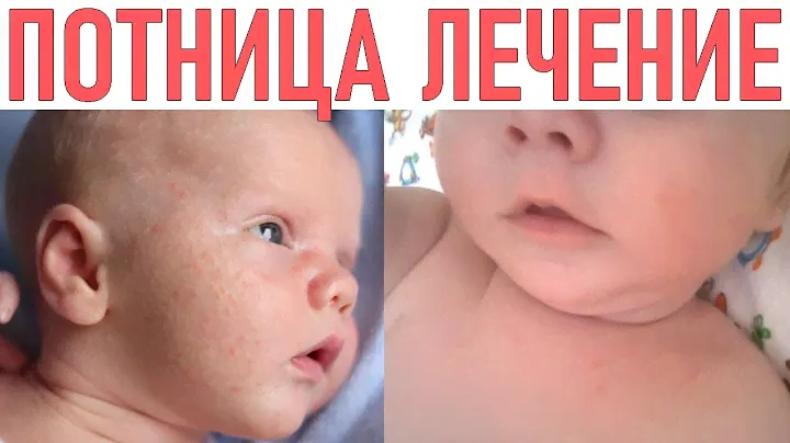 ПОТНИЦА У РЕБЕНКА | Как лечить, симптомы и профилактика